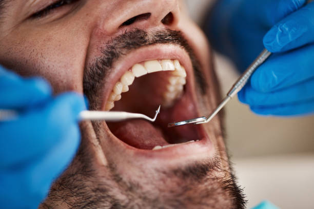 Best Teeth Whitening  in Elk City, OK